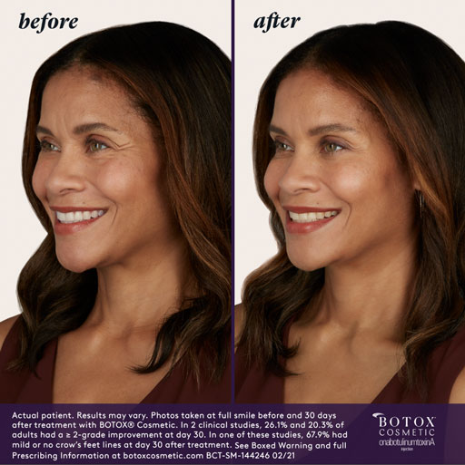BOTOX Before & After | Injectables