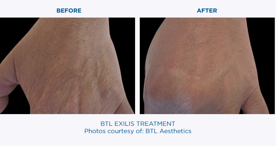 BTL EXILIS Before & After | Skin Tightening