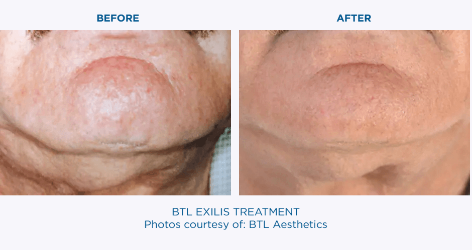 BTL EXILIS Before & After | Skin Tightening