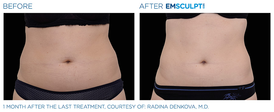 EMSCULPT NEO Before & After | Body Contouring