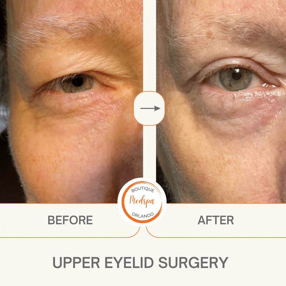 before_after eyelid Surgery